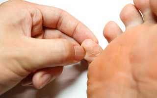 Чем нужно лечить грибок между пальцами ног? Полезные советы и рекомендации