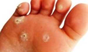 Что такое дисгидротическая форма грибка стопы и как ее лечить эффективно и безопасно