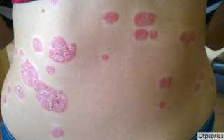 Псориатическая триада – что в себя включает?