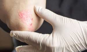 Возникновение псориаза на нервной почве: причины и последствия