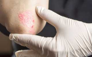 Возникновение псориаза на нервной почве: причины и последствия