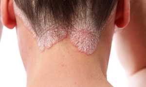 Что такое себорейный псориаз — симптомы и причины появления, а также методы лечения