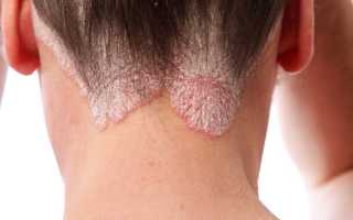 Что такое себорейный псориаз — симптомы и причины появления, а также методы лечения