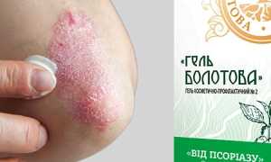 Эффективные способы для лечения псориаза в домашних условиях: советы и рекомендации