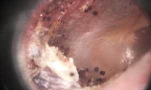 Как лечить ушной грибок при помощи мази или других препаратов эффективно и безопасно