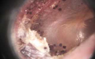 Как лечить ушной грибок при помощи мази или других препаратов эффективно и безопасно