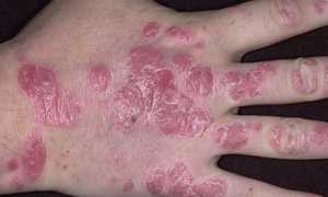 Эффективные способы лечения псориаза на руках для улучшения качества жизни