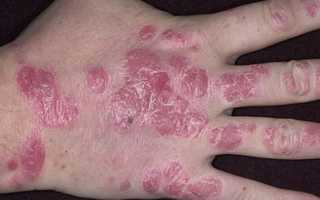 Эффективные способы лечения псориаза на руках для улучшения качества жизни