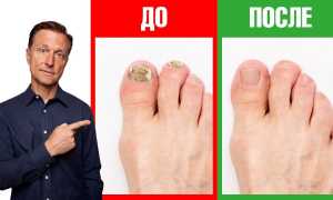 Помогает ли уксусная эссенция от грибка ногтей: мнение специалистов