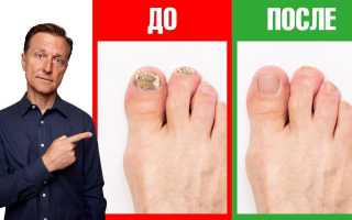 Помогает ли уксусная эссенция от грибка ногтей: мнение специалистов