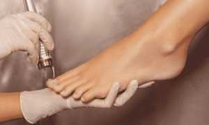 Лазерная процедура удаления грибка ногтей для здоровья