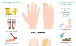 Грибковое поражение ногтей на ногах: причины и лечение