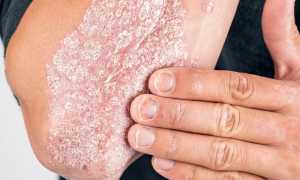Лечение препаратом Рsoricontrol кожного заболевания — псориаз и его особенности