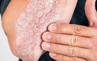 Лечение препаратом Рsoricontrol кожного заболевания — псориаз и его особенности