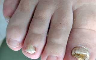 Грибок на ногтях ног: к какому врачу обратиться для лечения?
