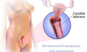 Причины молочницы после овуляции у женщин
