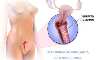 Причины молочницы после овуляции у женщин