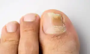 Лечение грибковой инфекции на ногтях при помощи яблочного уксуса: эффективные методы и советы