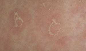 Отличия везикулярного грибка от других видов, и способы его лечения для здоровья