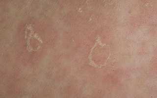 Отличия везикулярного грибка от других видов, и способы его лечения для здоровья