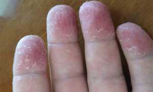 Причины возникновения и способы лечения грибка рук: полезные советы