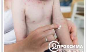 Почему появляется грибок у детей и как его лечить правильно