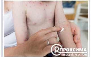 Почему появляется грибок у детей и как его лечить правильно