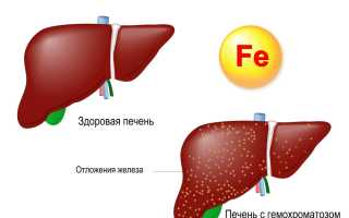 Гемохроматоз что это такое