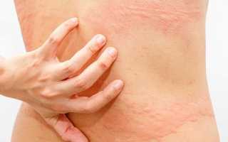Чем и как лечить грибок под подмышками — полезные советы для здоровья