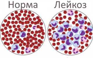Острый лейкоз это