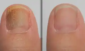 Распространенная патология — кандидозный грибок ногтей: причины и лечение