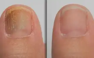 Распространенная патология — кандидозный грибок ногтей: причины и лечение