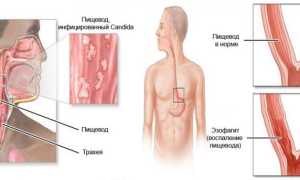 Заболевание Кандидоз пищевода — диагностика и методы лечения для здоровья