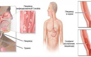 Заболевание Кандидоз пищевода — диагностика и методы лечения для здоровья