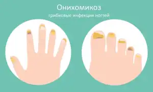 Эффективные способы лечения грибка ногтей на руках народными средствами в домашних условиях