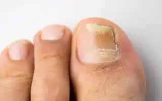 Как в домашних условиях вылечить уксусом грибок ногтей эффективно и безопасно