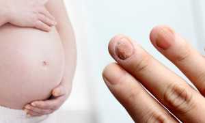 Как следует лечить грибок на ногах при беременности? Полезные советы и рекомендации