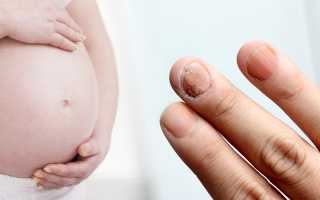 Как следует лечить грибок на ногах при беременности? Полезные советы и рекомендации