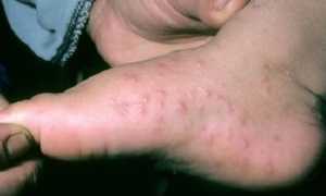 Как лечить грибок стопы у ребенка народными средствами в домашних условиях