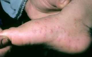 Как лечить грибок стопы у ребенка народными средствами в домашних условиях