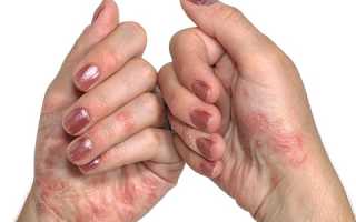 Эффективное лечение псориаза в домашних условиях активированным углем: советы и рекомендации