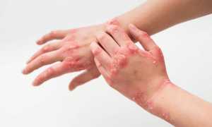 В борьбе с кожным заболеванием — псориаз какой врач сможет помочь? Узнайте больше