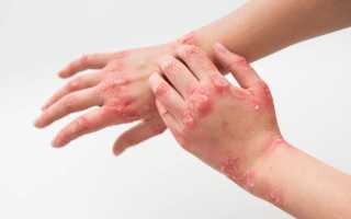 В борьбе с кожным заболеванием — псориаз какой врач сможет помочь? Узнайте больше