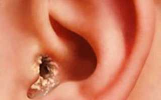 Что такое отомикоз и какими препаратами следует лечить? Полное руководство