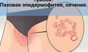 Что такое паховый дерматомикоз и как от него избавиться навсегда