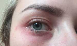 Как нужно лечить псориаз на глазах? Полезные советы и рекомендации