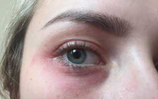 Как нужно лечить псориаз на глазах? Полезные советы и рекомендации