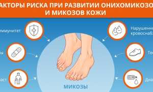 Особенности лечения грибковой инфекции ногтимицином: важные аспекты и рекомендации