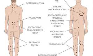 Как ставить пиявки