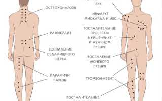Как ставить пиявки